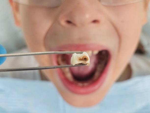 Best Emergency Dentist for Lost Fillings or Crowns in Bret Harte, CA